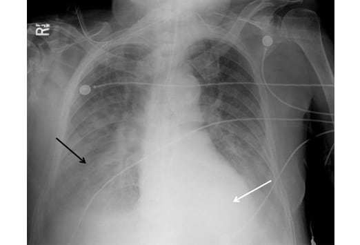 ap chest radiograph