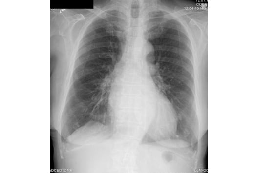 Normal Female Chest Radiograph –