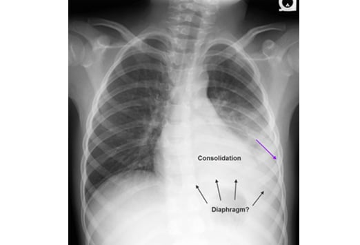 lateral chest xray