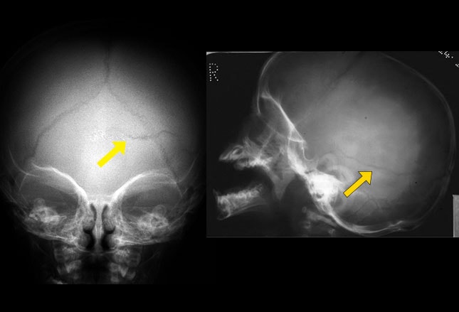 Fractured Rib Pictures