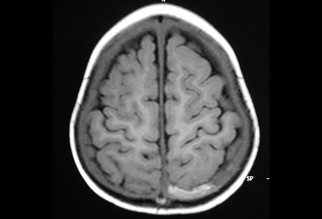 intracranial bleed