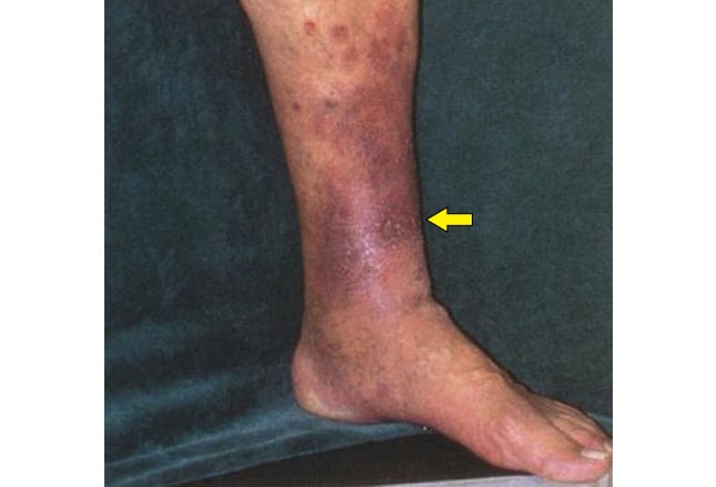 Skin Discoloration On Legs