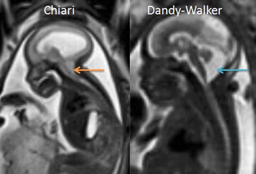 dandy walker syndrome