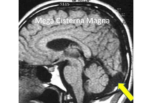 Normal Fetal Cisterna Magna Mri