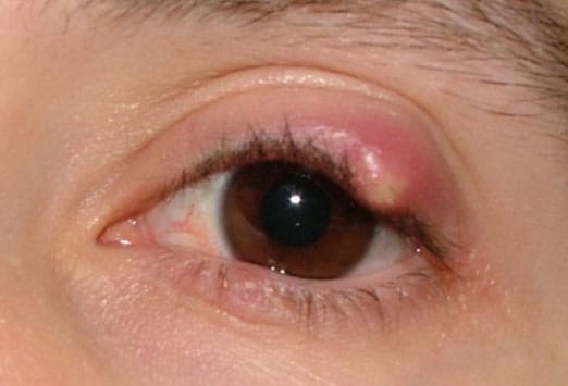 meibomian gland inflammation