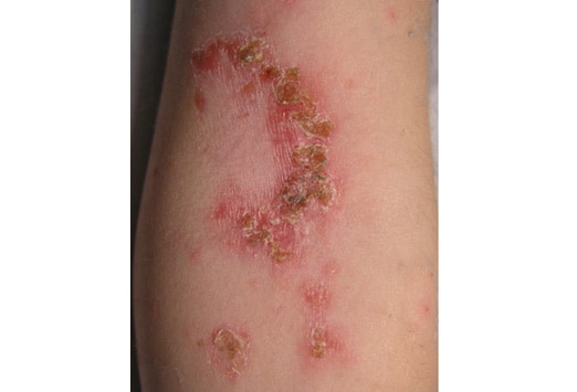 impetigo in adults. in size) with minimal