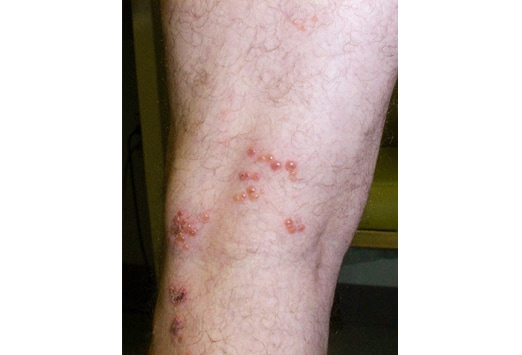 Common Rashes Not To Miss Slideshow 6463