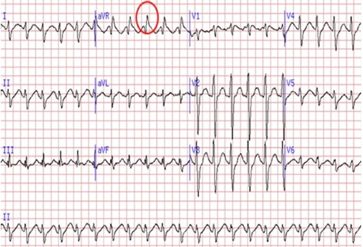 Digoxin Ekg