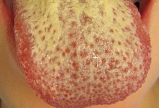 Candidiasis - Wikipedia