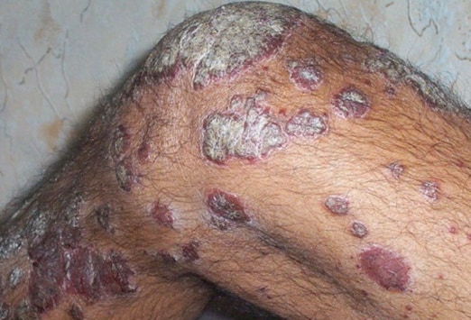 hiv rash feet