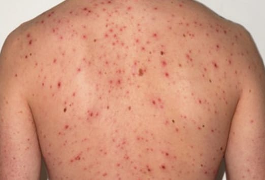 maculopapular rash hiv