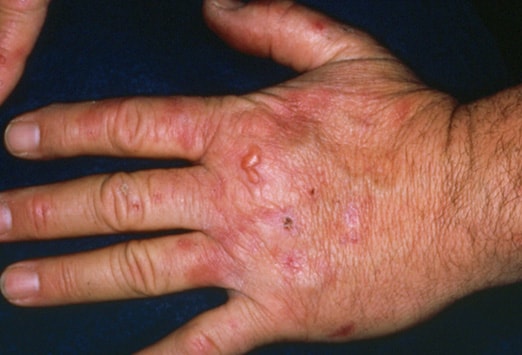 Herpes On Forearm