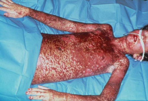 Stevens Johnson syndrome / toxic epidermal necrolysis ...