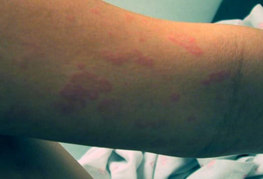 Cephalosporin Rash