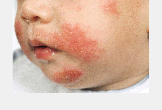 Irritant+contact+dermatitis+pictures