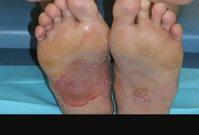 systemic poison ivy pictures. systemic corticosteroids,