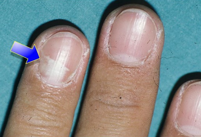 nevus at the nail base, breast cancer, melanoma (check for periungual