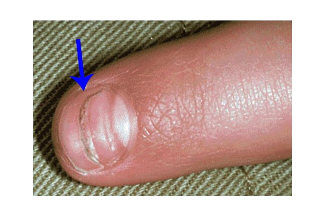 In contradistinction, onycholysis is distal separation of the nail plate