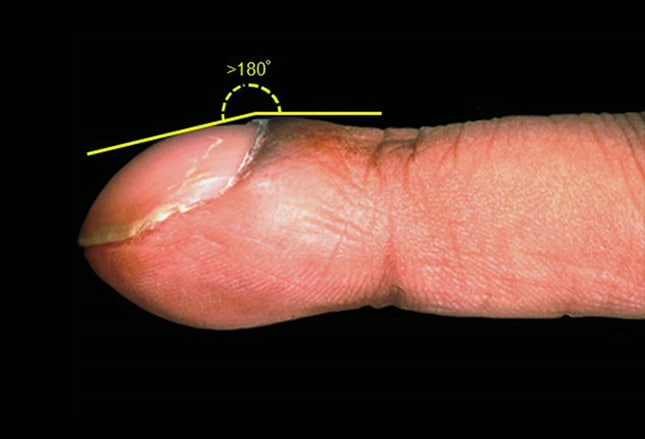 Nail clubbing occurs when the angle made by the proximal nail fold and nail