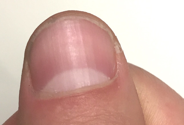 Changes in the color of the nail bed due to health conditions - wide 5