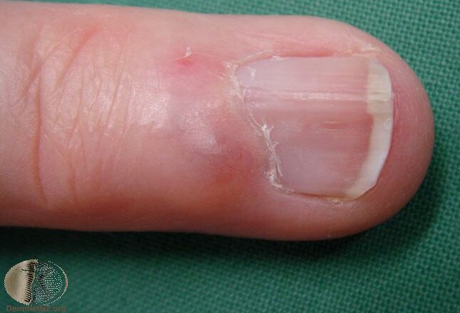 Fingernail And Toenail Abnormalities Nail The Diagnosis