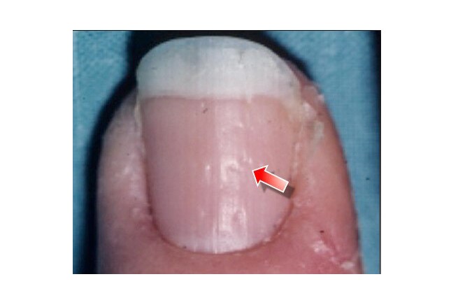 Fingernail And Toenail Abnormalities: Nail The Diagnosis