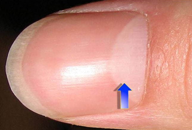 4. Nail Bed Color and Iron Deficiency Anemia - wide 2