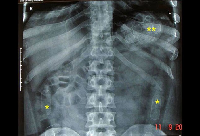 foreign body radiograph