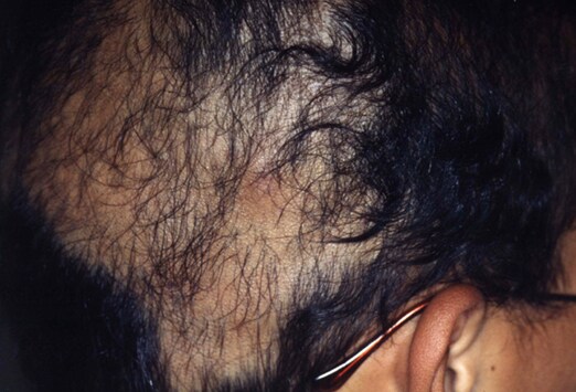 hair diseases #11