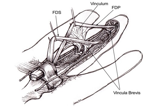 profundus tendon