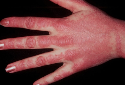 rash on knuckles