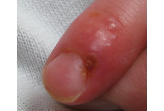 A dark lesion on the finger - Clinical Advisor