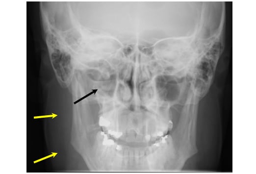 peritonsillar abscess x ray