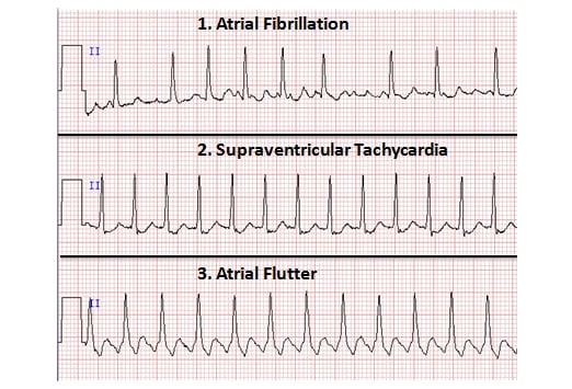 atrial fibrillation vs flutter