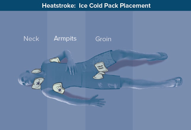 Heat Illness How To Cool Off Hyperthermic Patients heat-illness-how-to-cool-off-hyperthermic-patients
