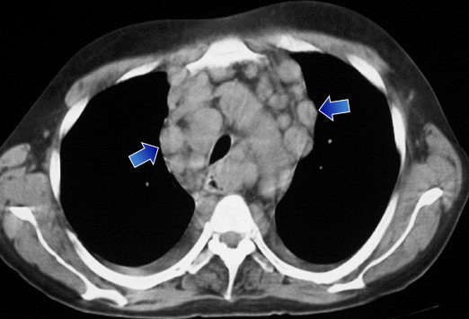 Enlarged Lymph Nodes In Abdomen Porn Sex Picture