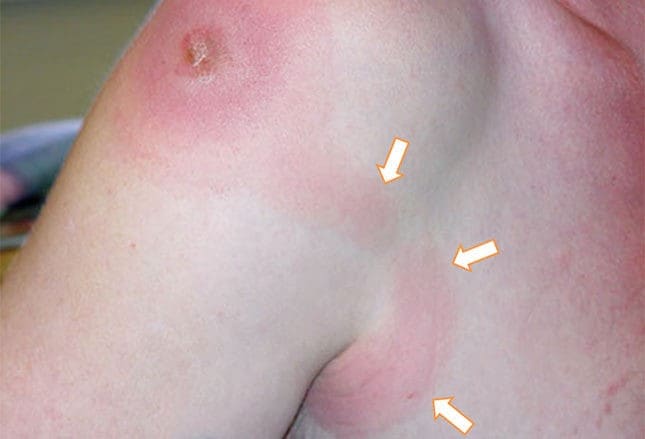 Cellulitis Red Streaks