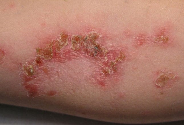 bacterial-skin-rash-pictures-photos