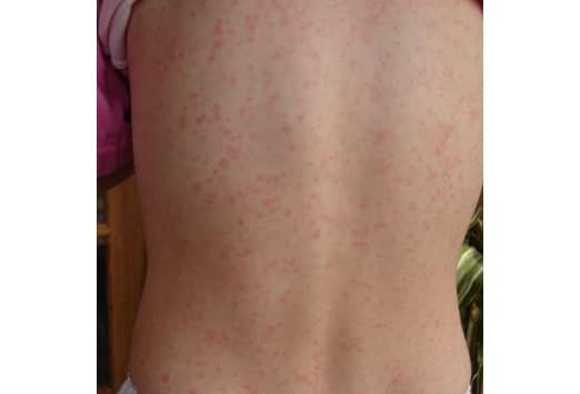 skin infections treated keflex