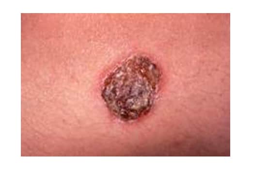 Candida infection of the skin: MedlinePlus Medical ...