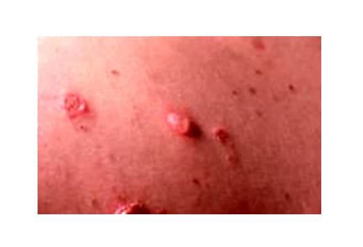 Group A Streptococcal Infections: Learn About Treatment