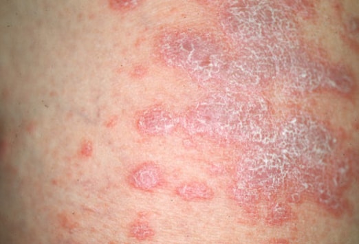 Lichen planus - Wikipedia