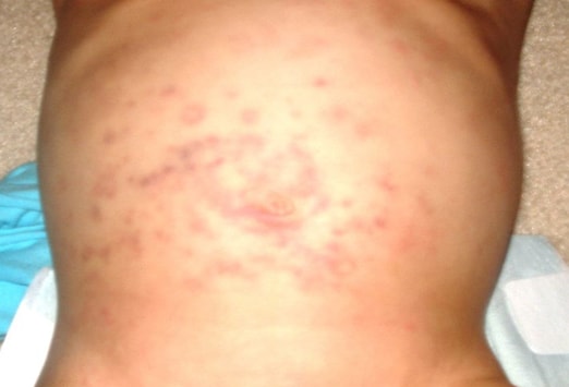 genital skin rashes #10