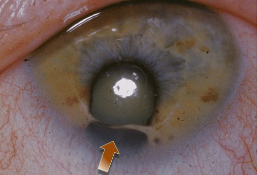 What The Eyes Tell You Abnormalities Of The Iris