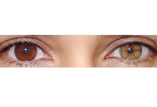 What the Eyes Tell You: Abnormalities of the Iris