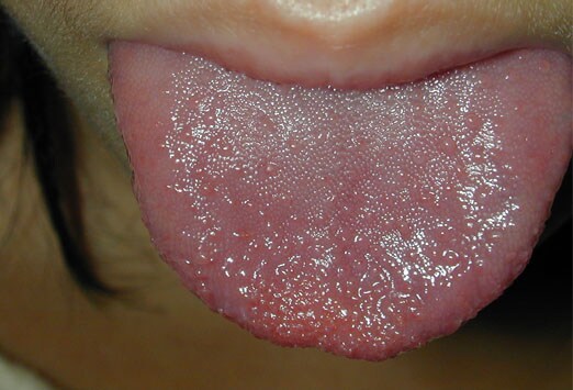 Swollen Papillae Tongue