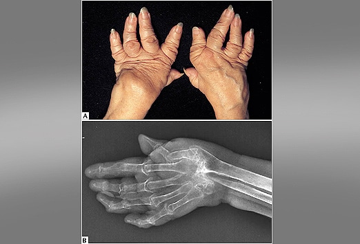 Notable Knuckles: Evaluating Arthritic Conditions of the Hand