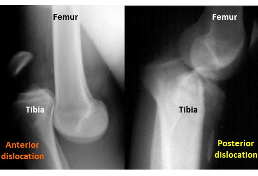 Best Practices: Effective Reduction Techniques For Lower Extremity 