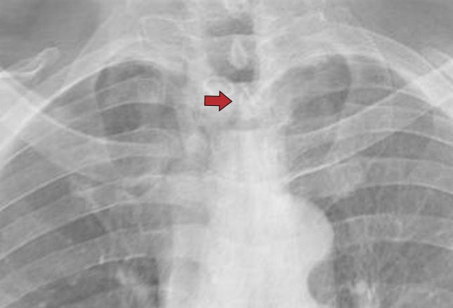 Cavitary Lung Lesion