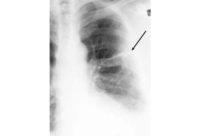 post op wound infection icd 10